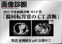 典型的な虫垂炎症例の連続画像公開中です